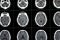 Brain CT scan showing brainstem cavernoma, right centrum semiovale developmental venous anomaly, intra cerebral haematoma, faint