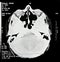 Brain CT View