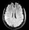 Brain extra axial convexity mass lesion mri exam