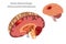 Brain Hemorrhage Intracranial hematoma