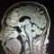 Brain meningioma pointing mri examination