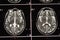 Brain MRI