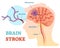 Brain Stroke anatomical vector illustration diagram, scheme