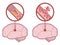 Brain stroke - ischemic and hemorrhagic