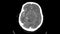 Brain tumor  Film CT-scan of brain : show part of brain with tumor