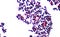 Branching budding yeast cells with pseudohyphae in urine gram st