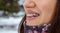 Brasket system in smiling mouth, macro photo teeth, close-up lips,