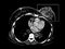 Breast cancer. CT-scan image isolated