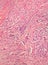 Breast Cancer Histology