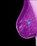 Breast cancer - mammogram