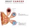 Breast Ductal cancer