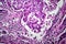 Breast ductal carcinoma, light micrograph