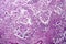 Breast ductal carcinoma, light micrograph