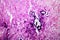 Breast fibroadenosis, light micrograph