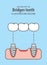 Bridges teeth illustration vector on blue background. Dental