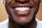 Brightening Smiles. Close-up of Black Males Impeccable White Teeth at a Cutting-Edge Dental Clinic