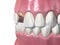 Broken central incisor tooth. Medically accurate 3D illustration of human teeth and dentures concept