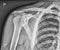 Broken clavicle bone fixation, Fracture repair