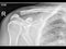 Broken clavicle bone fixation, Fracture repair