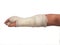 Broken hand plaster. right hand. male. isolated