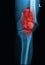 Broken human thigh x-rays image