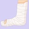 Broken leg in in a cast bandage, orthopedic gypsum, injury bone, vector illustration drawn in a flat style.