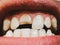 Broken tooth. Broken upper incisor in a man mouth