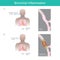 Bronchial Inflammation. Illustration.