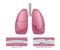 Bronchiectasis in lung infographic