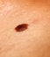 Brown birthmark. Brown mole large size. Stain on the skin