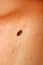 Brown birthmark. Brown mole large size. Stain on the skin