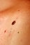 Brown birthmark. Brown mole large size. Stain on the skin