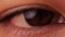 Brown eye blinking in Slow Motion. Woman is opening and closing her eye with Pterygium.