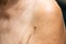 Brown mole on senior woman brachium, Medicine, Close up, Asian Body skin, Healthcare and Beauty concept