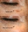 Brown spot on the skin of the face. Pigmentation on the skin. After laser removal