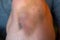 Bruise injury on knee. Close up image of person sitting on sofa and holding in hands wounded leg with hematoma.