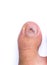 Bruise on toe nail on white background