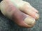 Bruised big toe- male.