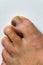 The bruised finger of the male foot close-up.