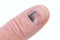Bruised finger nail