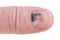 Bruised finger nail