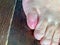 Bruised fractured little toe of a man in close up