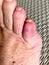 Bruised fractured little toe of a senior man