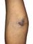 Bruises at elbow of Asian patient. Intravenous needle injury