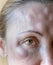 Bruises from on a woman\'s face