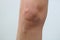 Bruises on the woman`s knee on white background