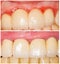 Buffing Teeth Tangent and with Shoulder