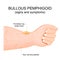 Bullous pemphigoid. autoimmune pruritic skin disease