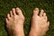 Bunion Comparison Left Foot deformed, Right  Foot Normal