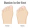 Bunion in the foot